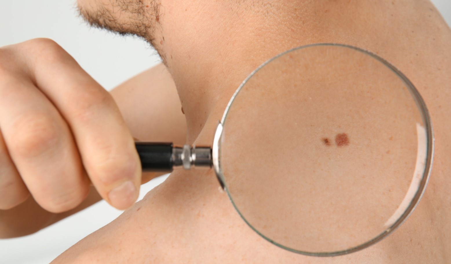 Как определить признаки рака кожи