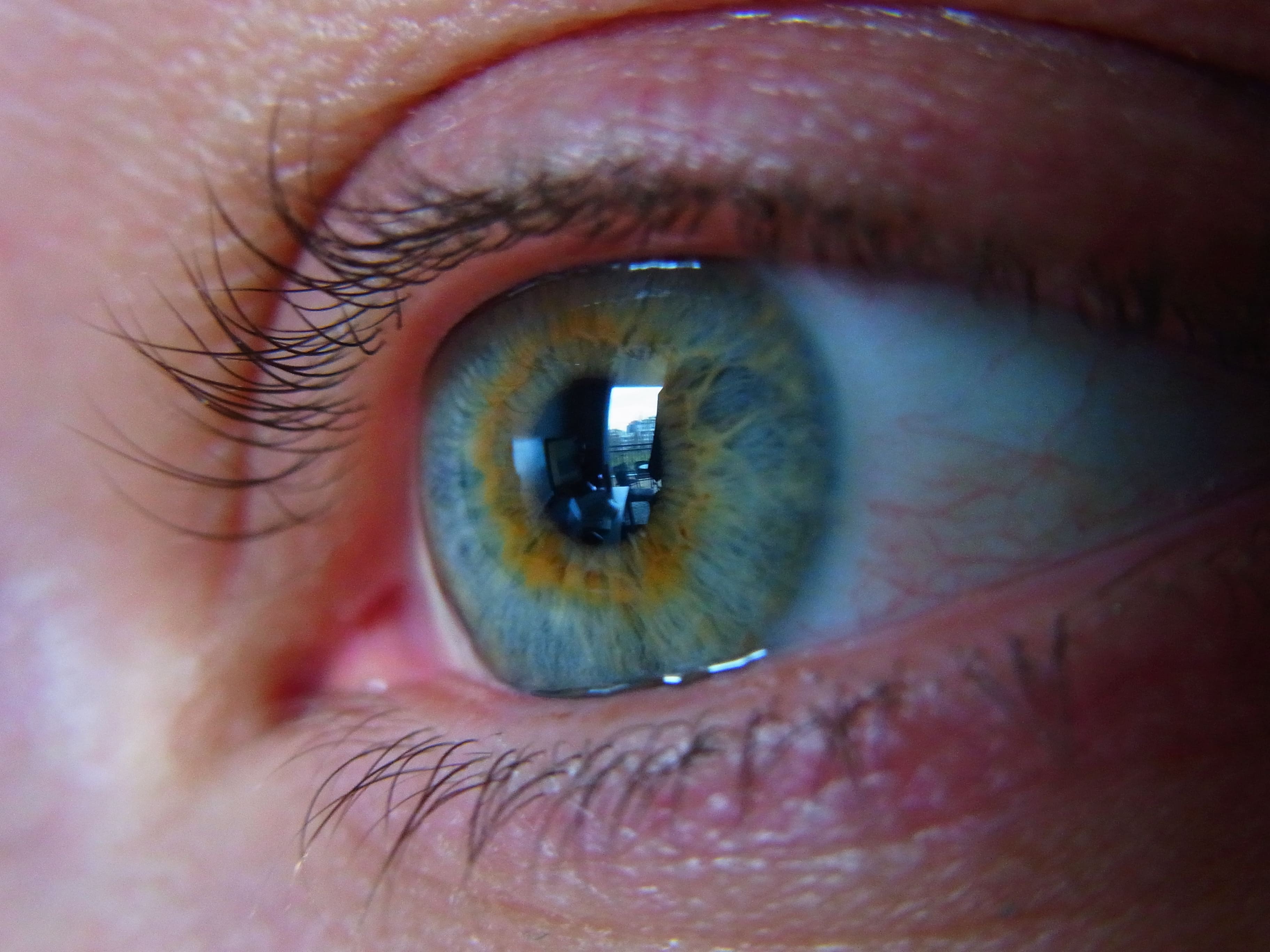 Неоперабельный рак лечился увлажняющими каплями для глаз: девушке осталось жить немного  
